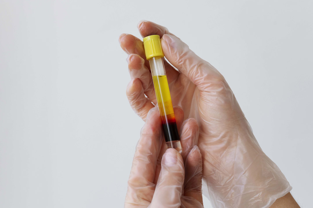 PRP ve Mezoterapi ile Cilt Yenilemesinde Çifte Etki