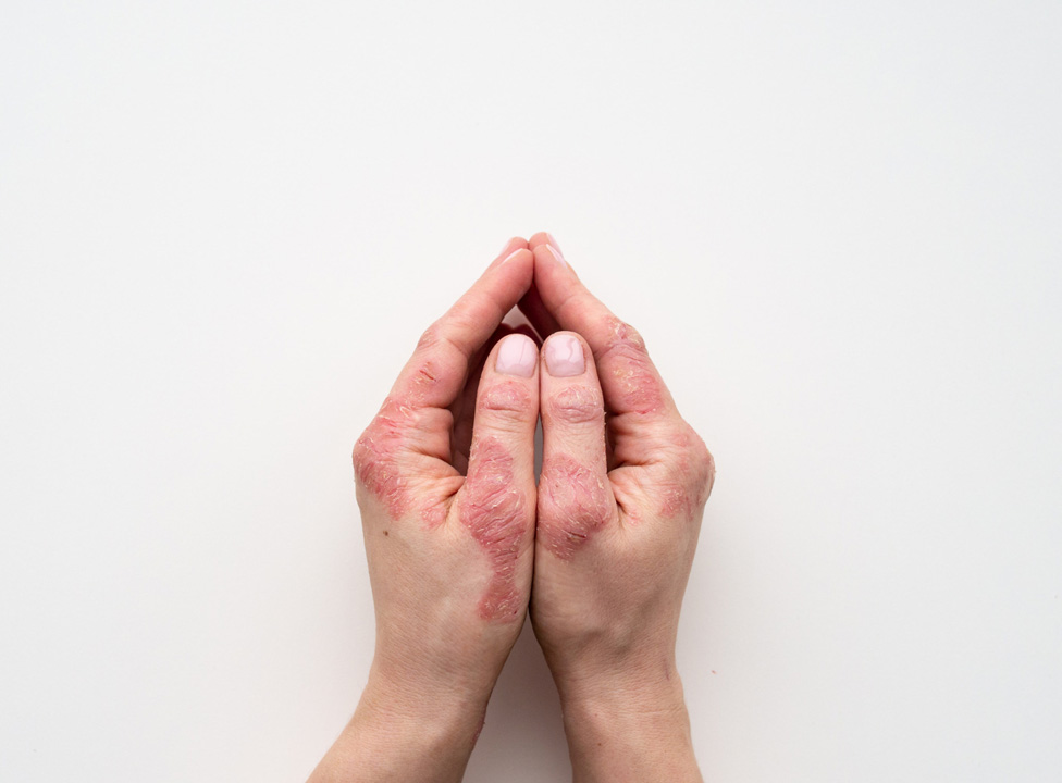 Sedef Hastalığı Hakkında Sık Sorulan Sorular Sedef Hastalığı Hakkında Sık Sorulan Sorular