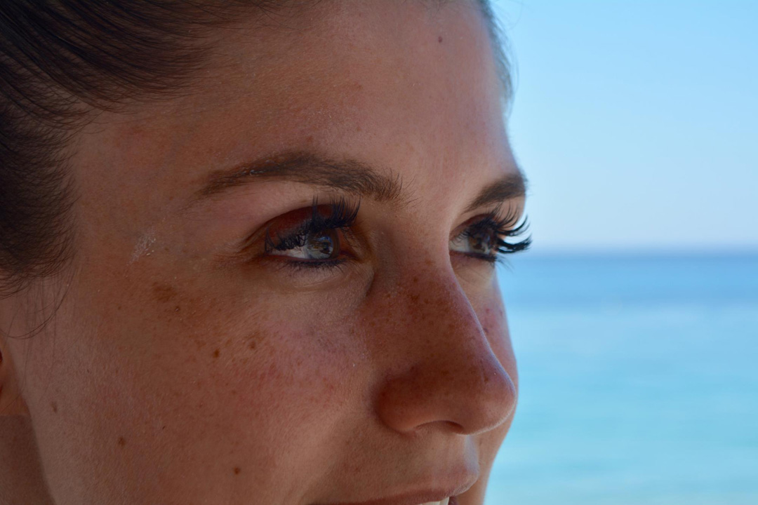 Solar Lentigo: Nedir, Nasıl Tedavi Edilir?