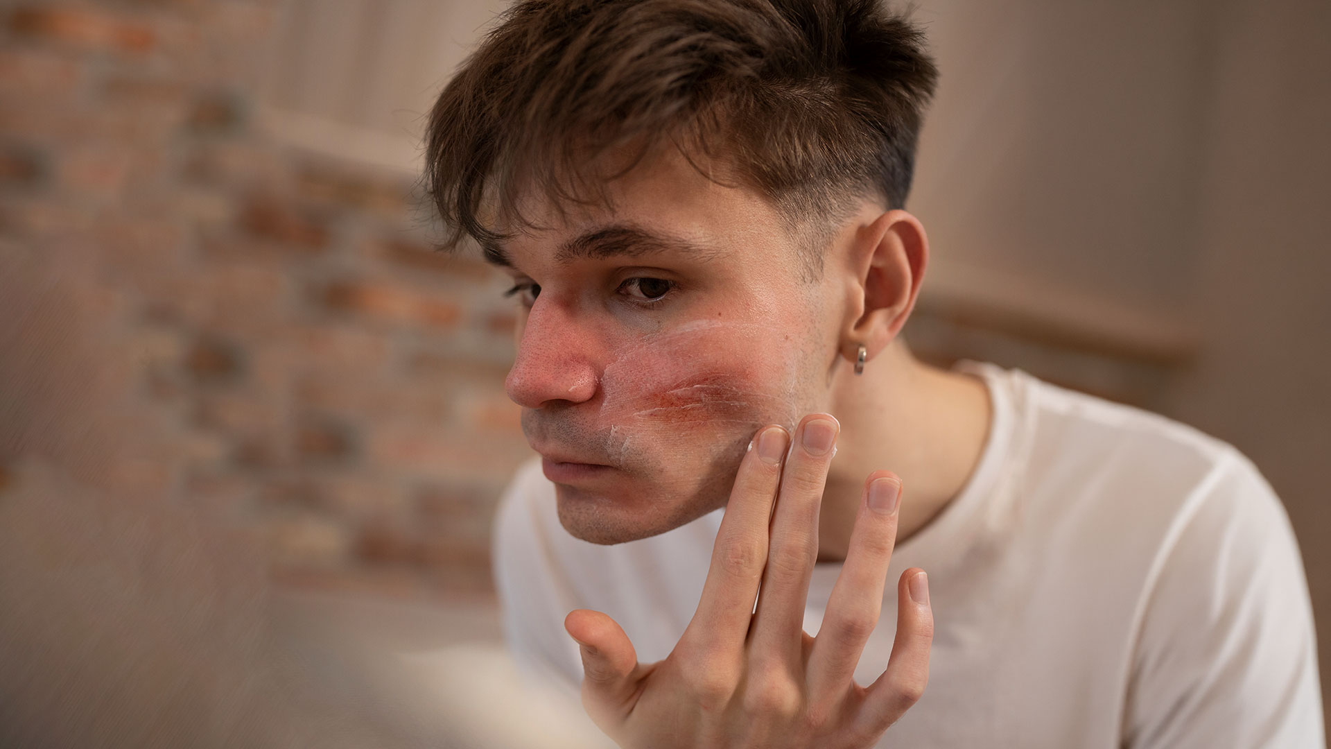 Demodeks: Nedir, Belirtileri, Tedavi Yöntemleri