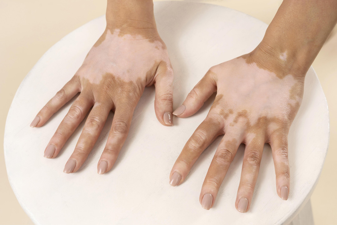 Vitiligo Nedir, Nasıl Tedavi Edilir? Vitiligo Nedir, Nasıl Tedavi Edilir?