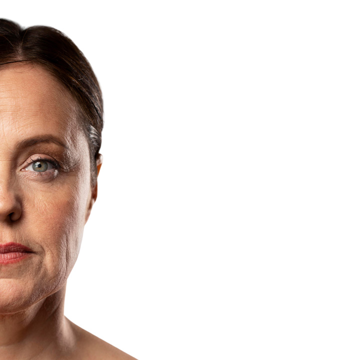 Yüzdeki İnce Kırışıklar ve Giderici Tedaviler Nelerdir? Yüzdeki İnce Kırışıklar ve Giderici Tedaviler Nelerdir?