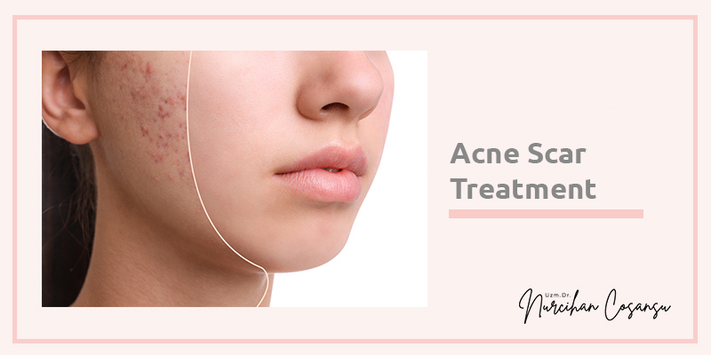 Acne Scar Treatment