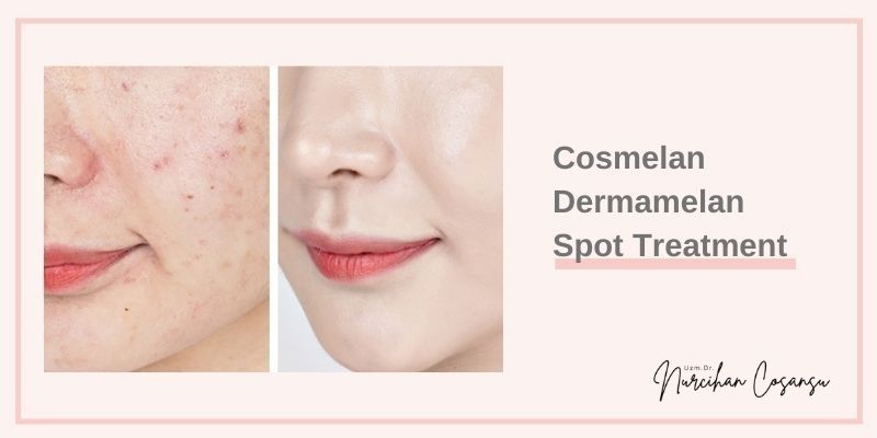 Cosmelan and Dermamelan Skin Spot Treatment