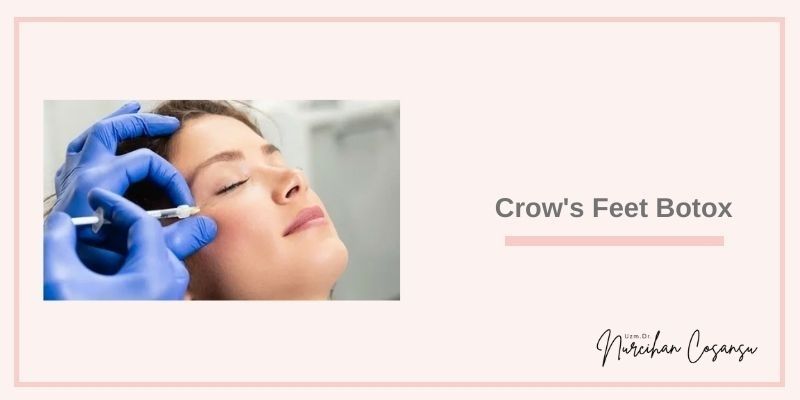 Crow's Feet Botox