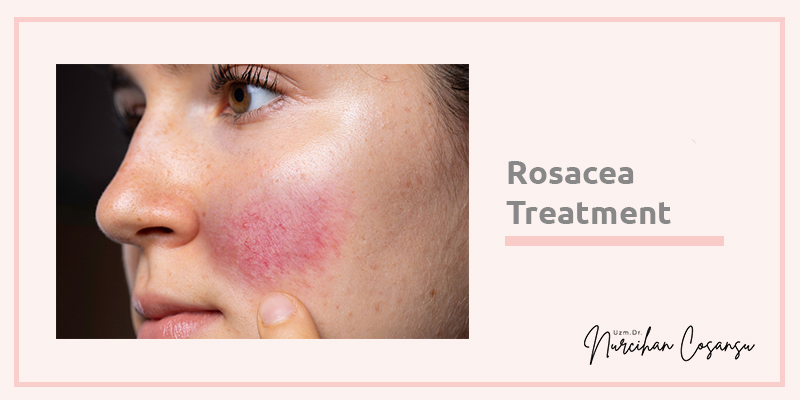 Rosacea