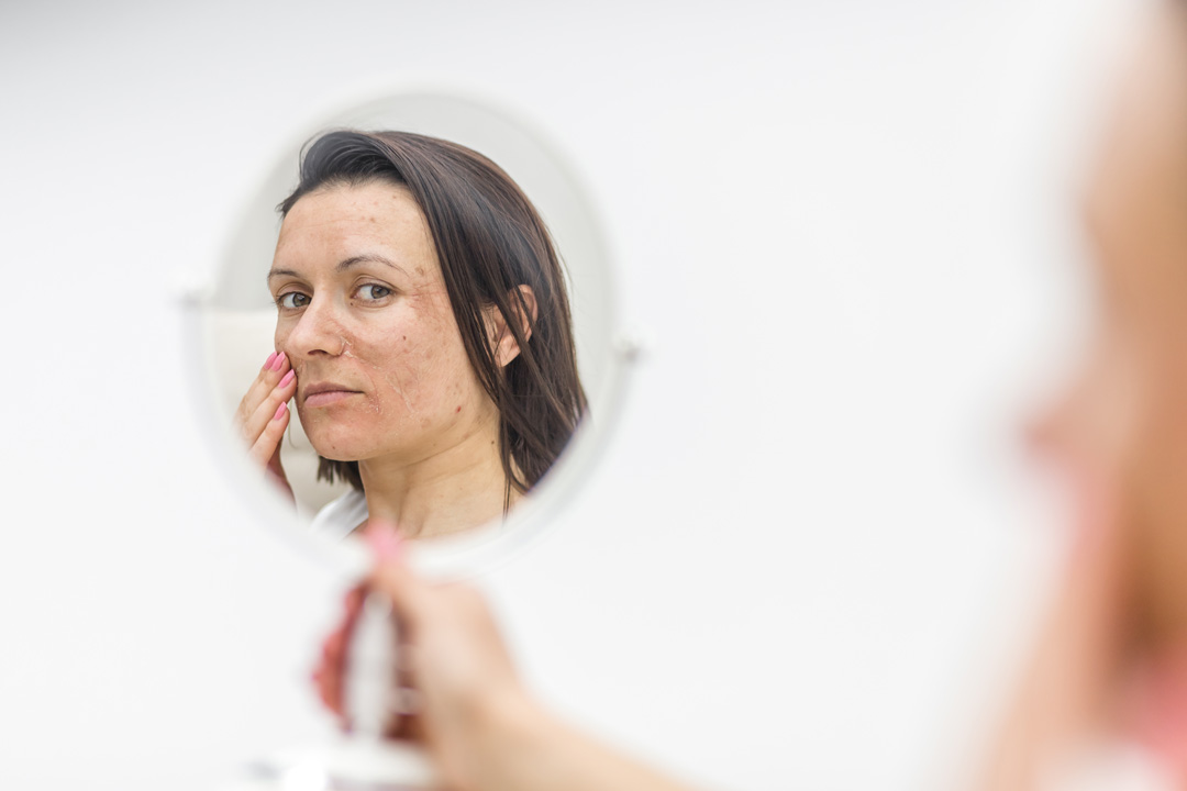 Hasarlı Cilt Tedavisinde Dermatolojik Yaklaşımlar