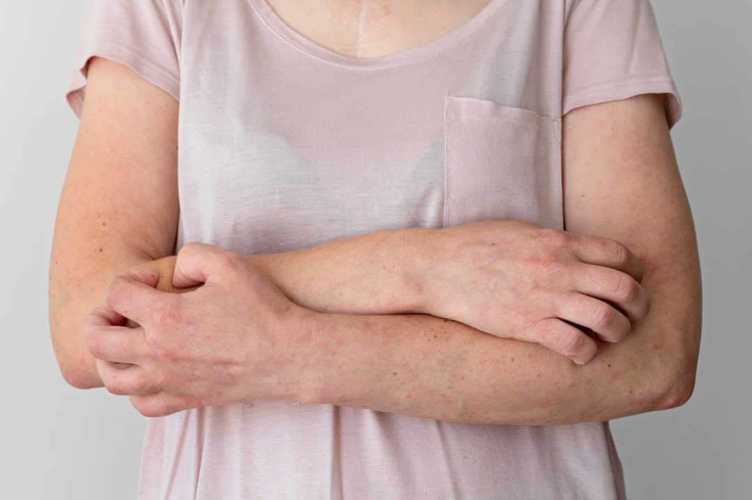 Atopik Dermatit Nedir? Tanı ve Tedavi Yöntemleri Nelerdir?