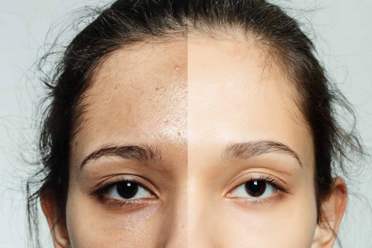 What Are the Differences Between Cosmelan and Dermamelan?
