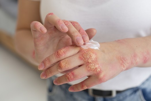 Clinical Solutions for Eczema Flare-Ups