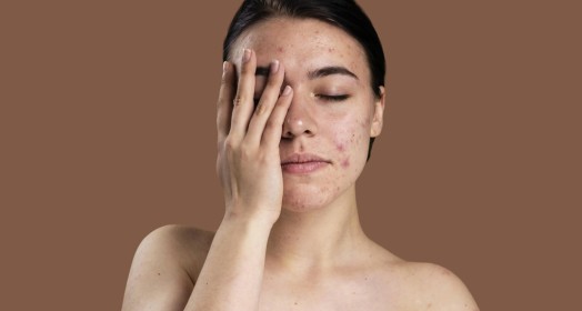 Hormonel Akne Tedavileri