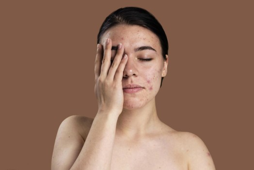 Hormonal Acne Treatments