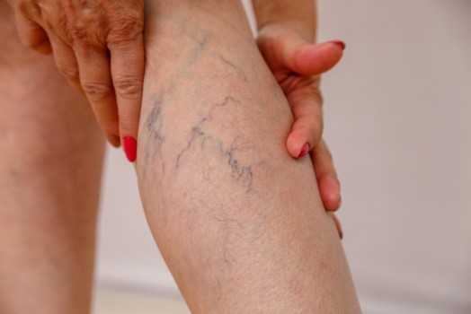 Types of Lasers Used in Spider Vein Treatment