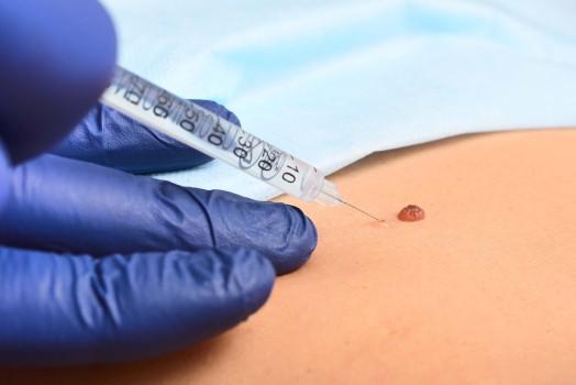 Frequently Asked Questions About Laser Mole Treatment