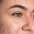 Lazerle Leke Tedavisi Hakkında Sık Sorulan Sorular
