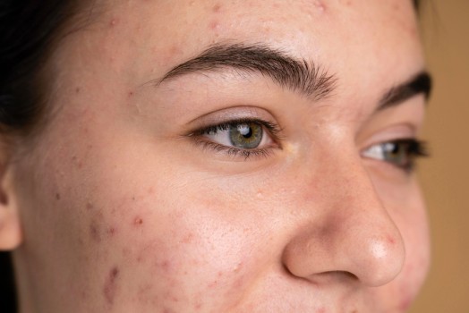 Frequently Asked Questions About Laser Pigmentation Treatment