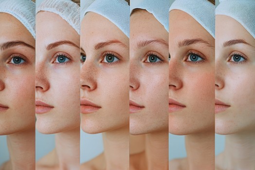 How Should Laser Selection Be Made According to Skin Type?