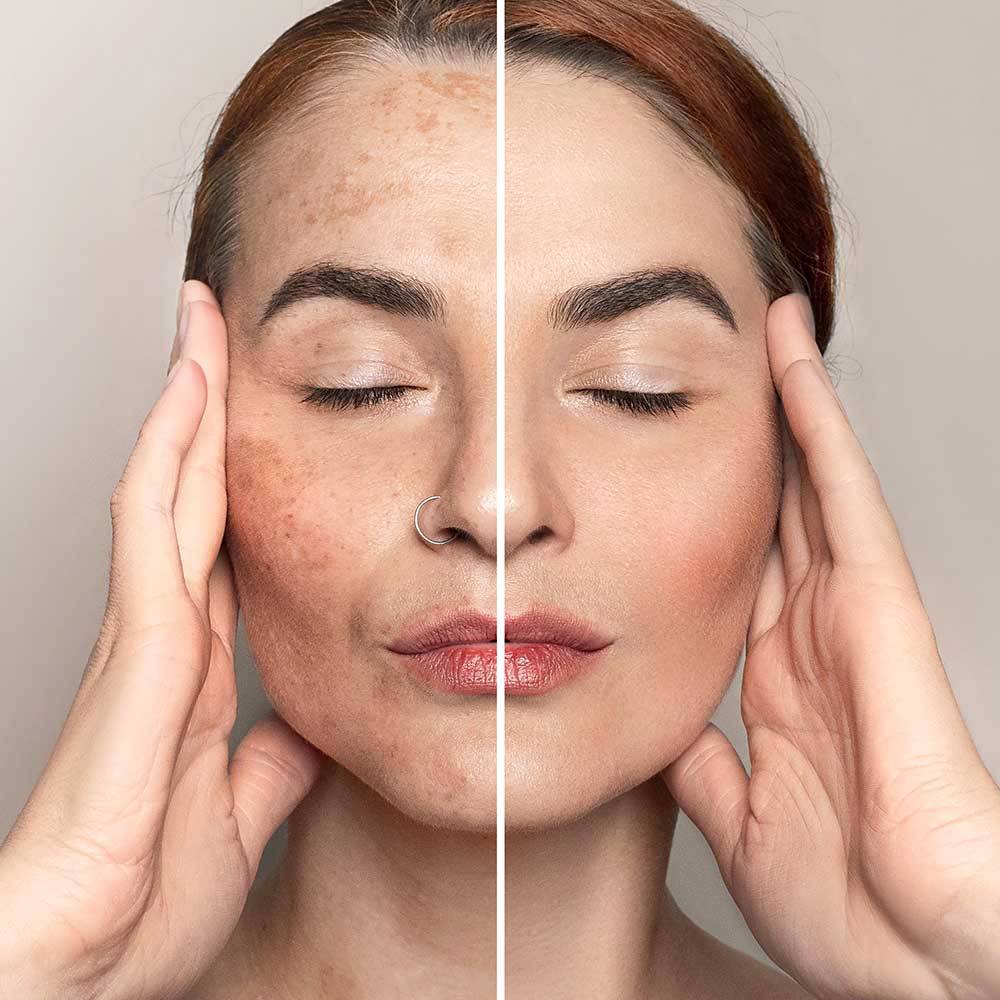Skin Spot Treatment