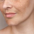 Melazma: Nedir, Neden Olur, Tedavisi Nedir?