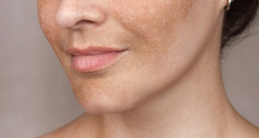 Melazma: Nedir, Neden Olur, Tedavisi Nedir?