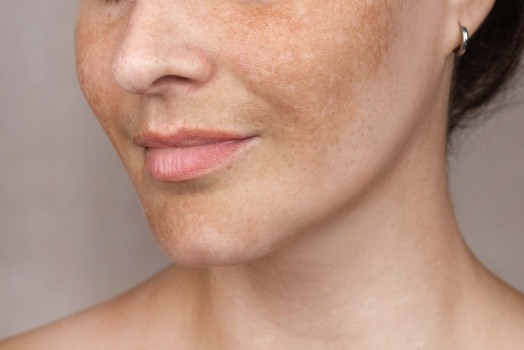 Melasma: What It Is, Causes, and Treatment