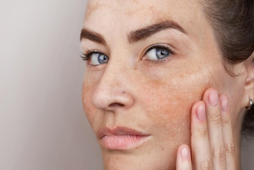 Pigmentation Treatment