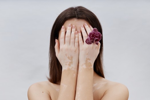 What Is Vitiligo and How Is It Treated?