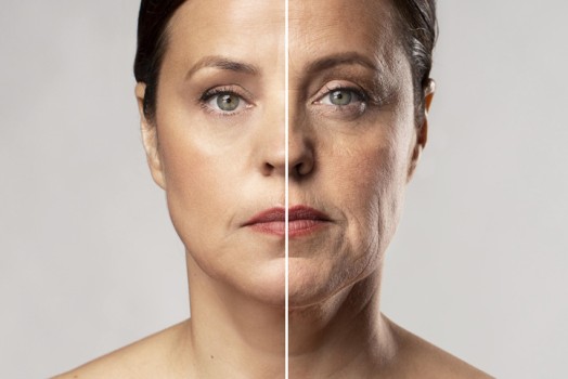 What Are Fine Facial Wrinkles and Their Treatments?